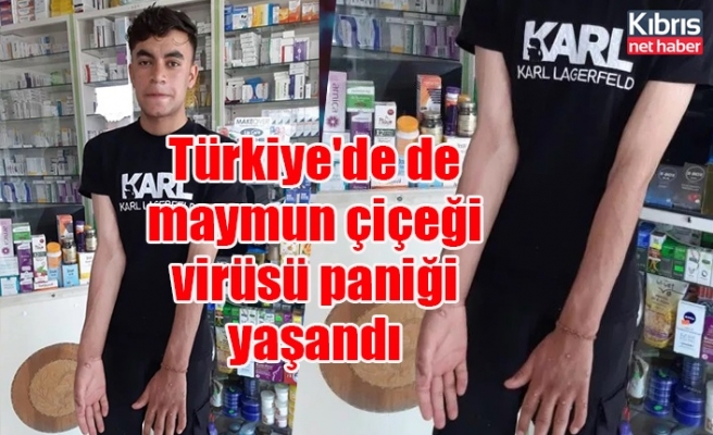 Türkiye'de de maymun çiçeği virüsü paniği yaşandı