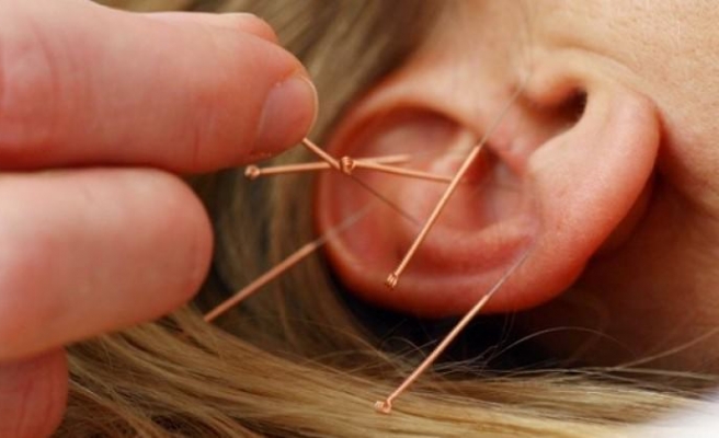 Kanser tedavisine yeni umut: Akupunktur